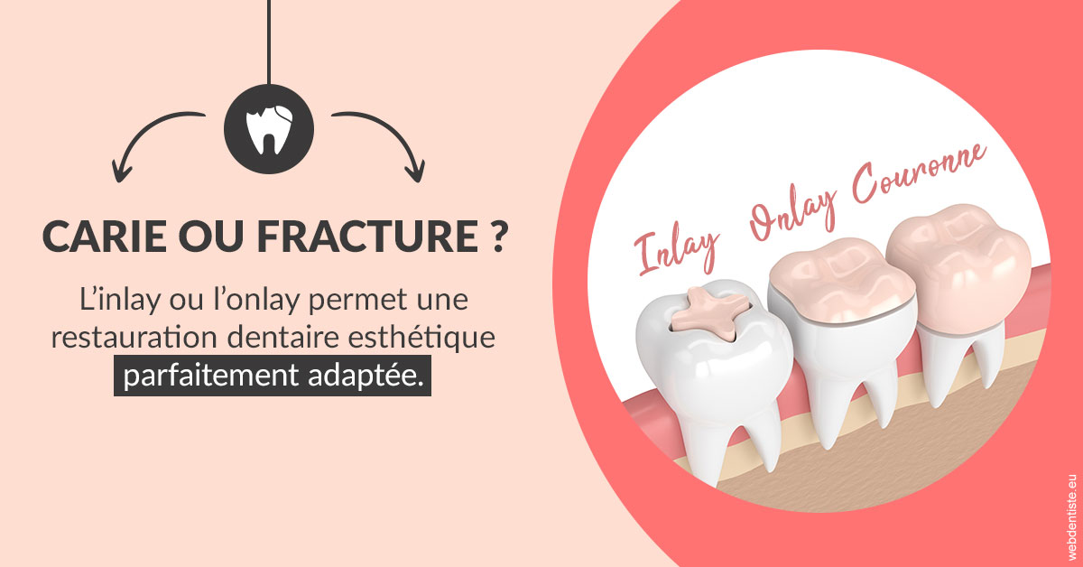 https://dr-bluche-laurent.chirurgiens-dentistes.fr/T2 2023 - Carie ou fracture 2
