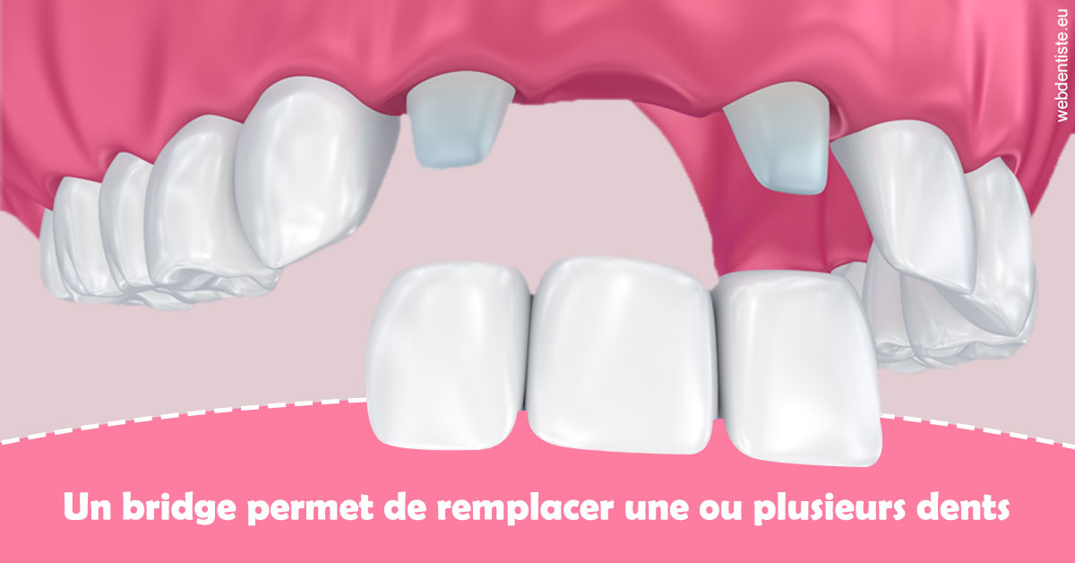 https://dr-bluche-laurent.chirurgiens-dentistes.fr/Bridge remplacer dents 2
