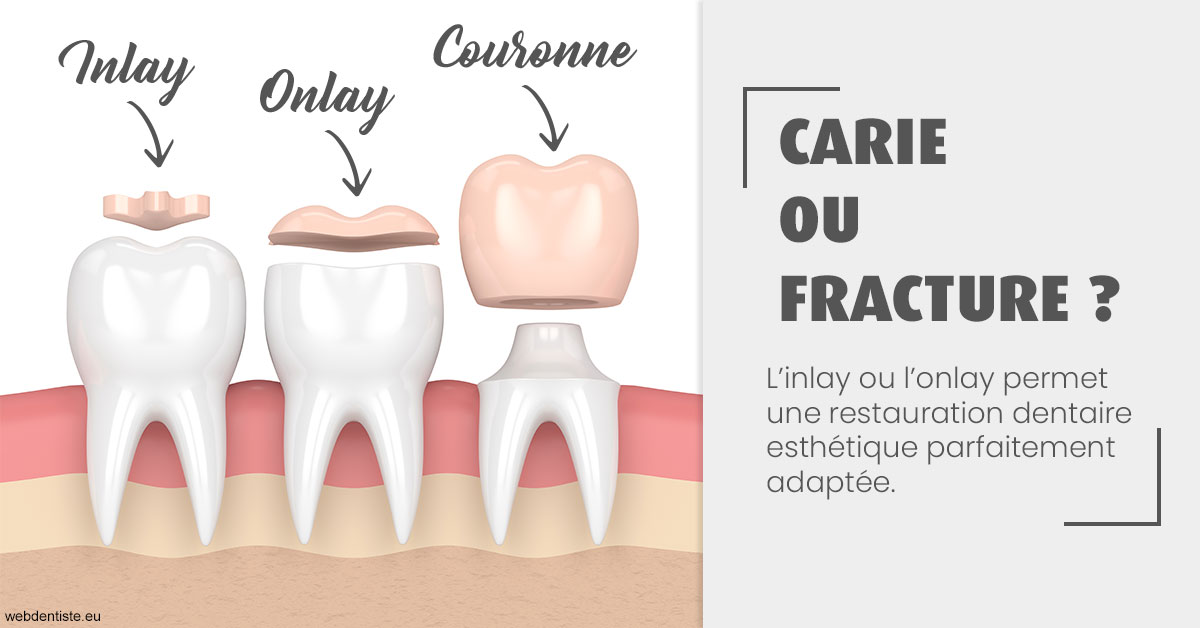 https://dr-bluche-laurent.chirurgiens-dentistes.fr/T2 2023 - Carie ou fracture 1