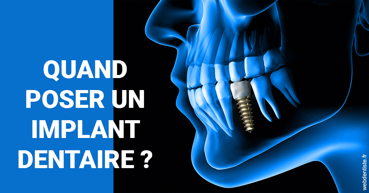 https://dr-bluche-laurent.chirurgiens-dentistes.fr/Les implants 1