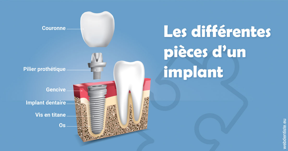https://dr-bluche-laurent.chirurgiens-dentistes.fr/Les différentes pièces d’un implant 1